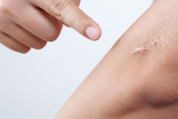 Can-You-Get-Rid-of-Scar-Tissue-After-Surgery-Injury-or-Acne_