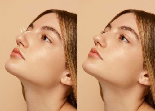 Second-Times-the-Charm_-A-Deep-Dive-into-Rhinoplasty-Revision